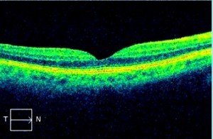 oct-scan-retina